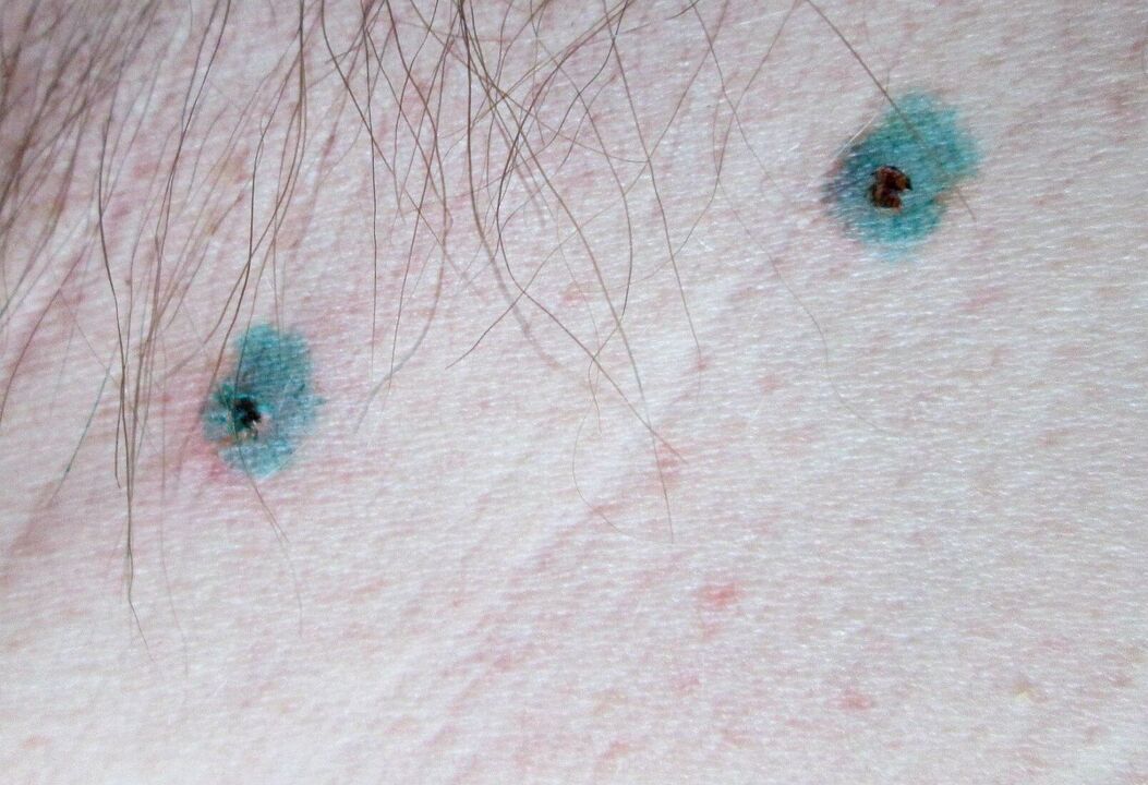 Markeringen op de huid na laserverwijdering van papillomen