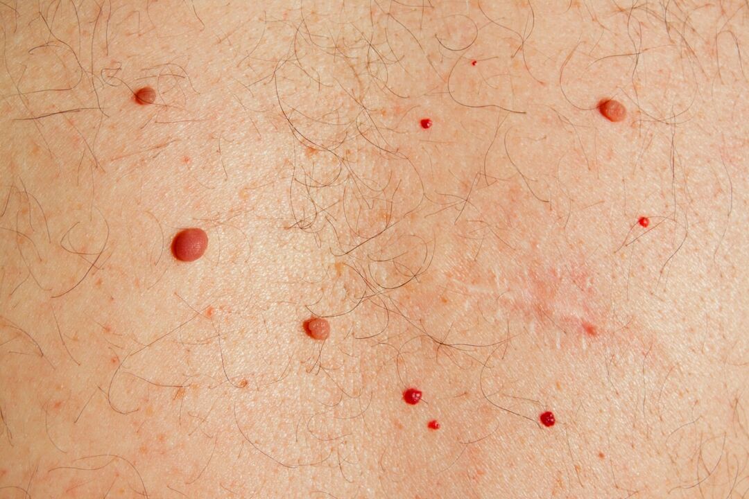 Papillomen op het lichaam veroorzaakt door HPV